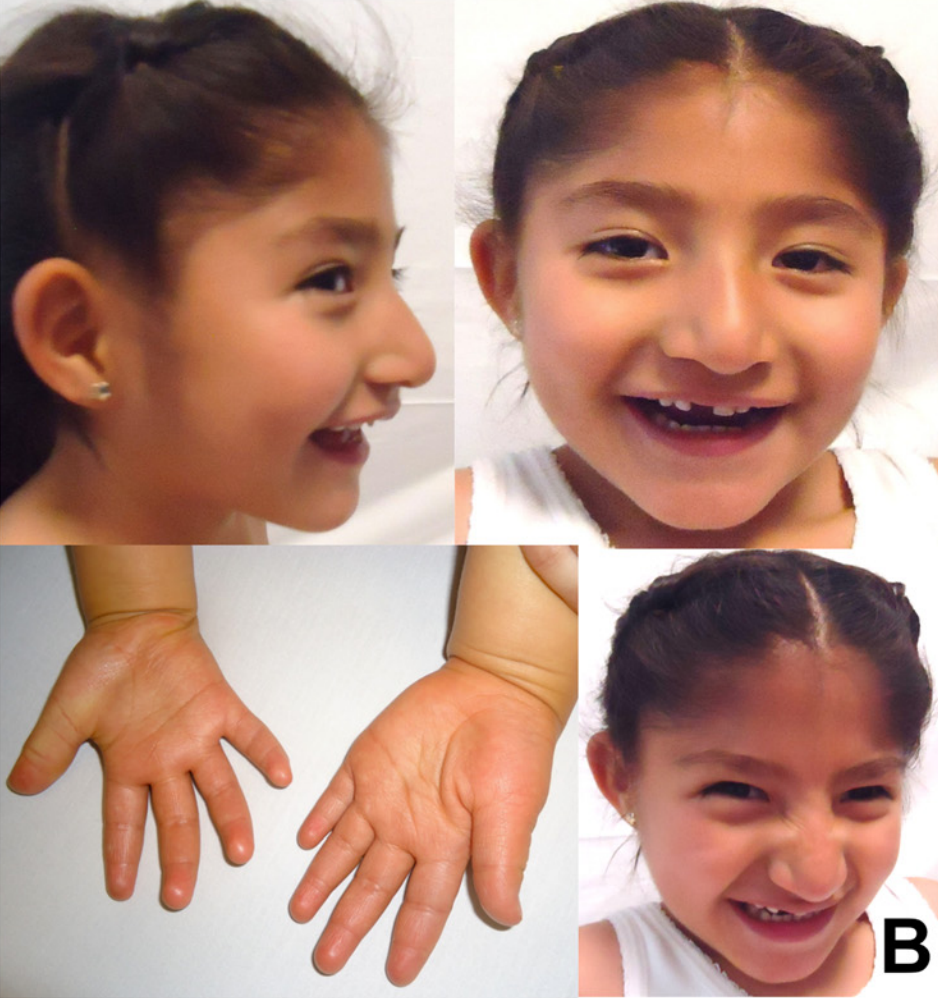 5-year-old_Mexican_girl_with_Angelman_syndrome_(cropped)